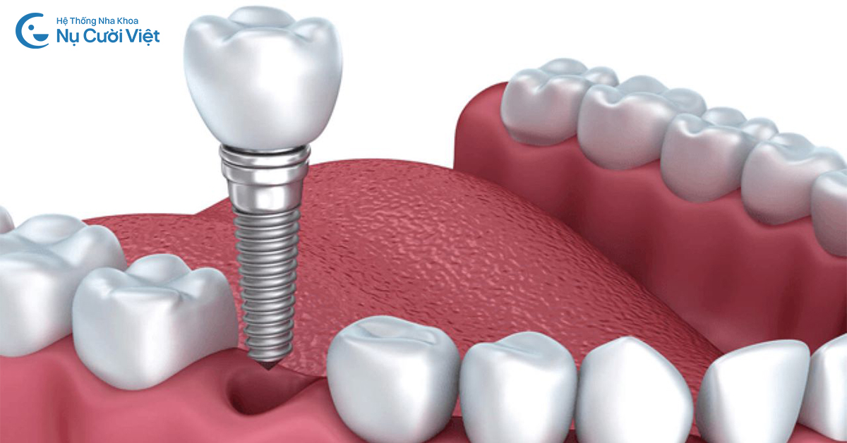trồng răng implant cho người  tiêu xương hàm