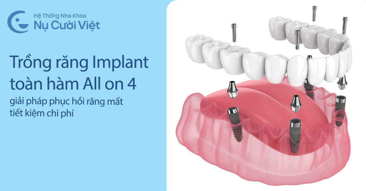 trồng răng implant toàn hàm all on 4 