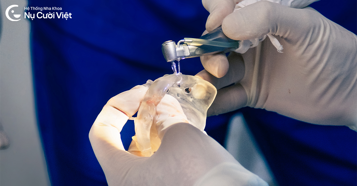 trồng răng implant toàn hàm không đau