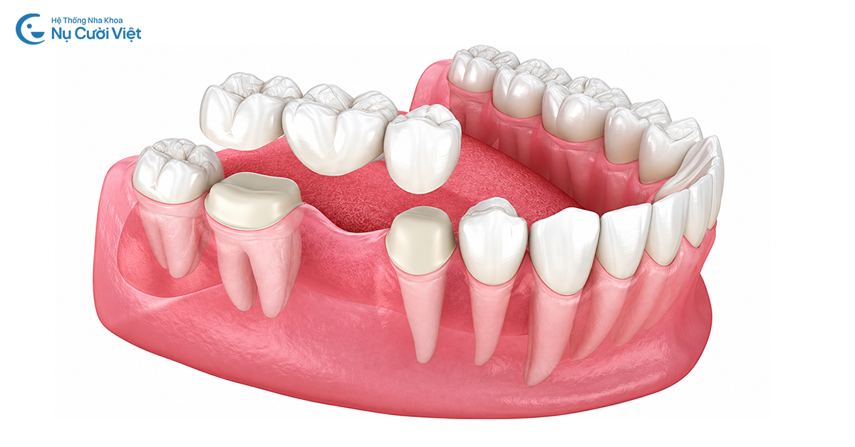 trồng răng số 6 cầu răng sứ