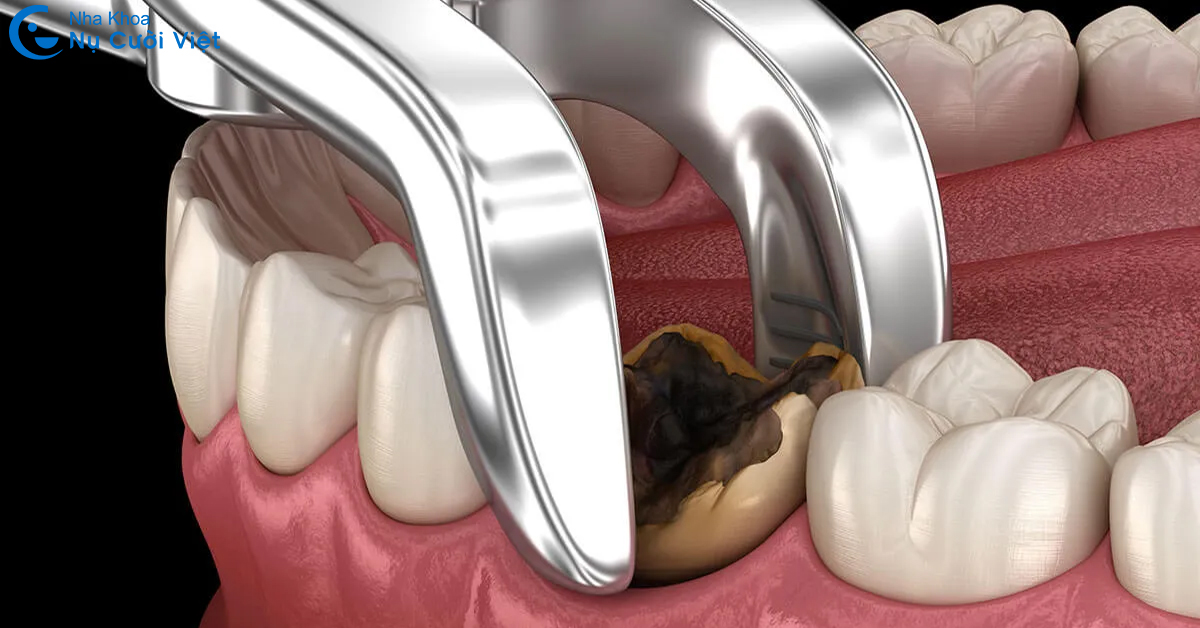 những trường hợp cần nhổ răng