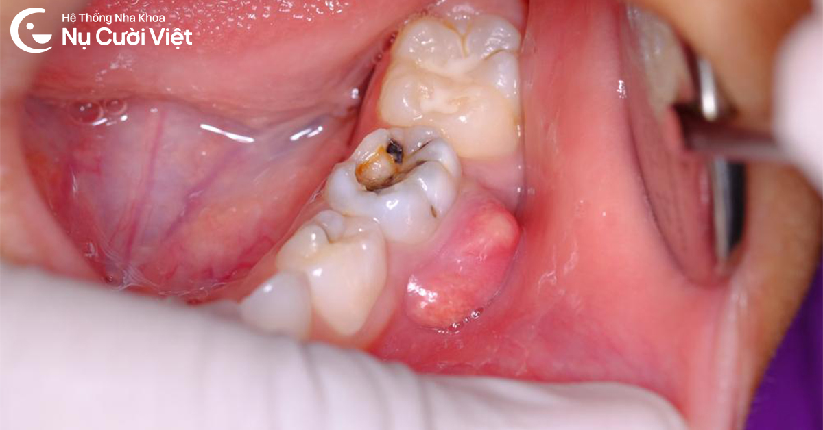 trường hợp không nên nhổ khi răng đang đau