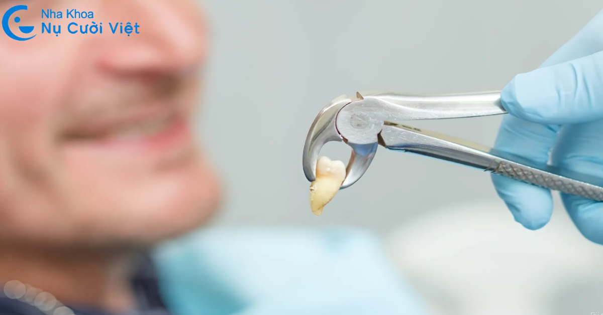 những trường hợp nên nhổ răng khôn sớm