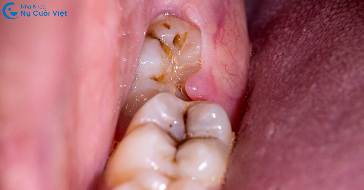 những trường hợp cần nhổ răng