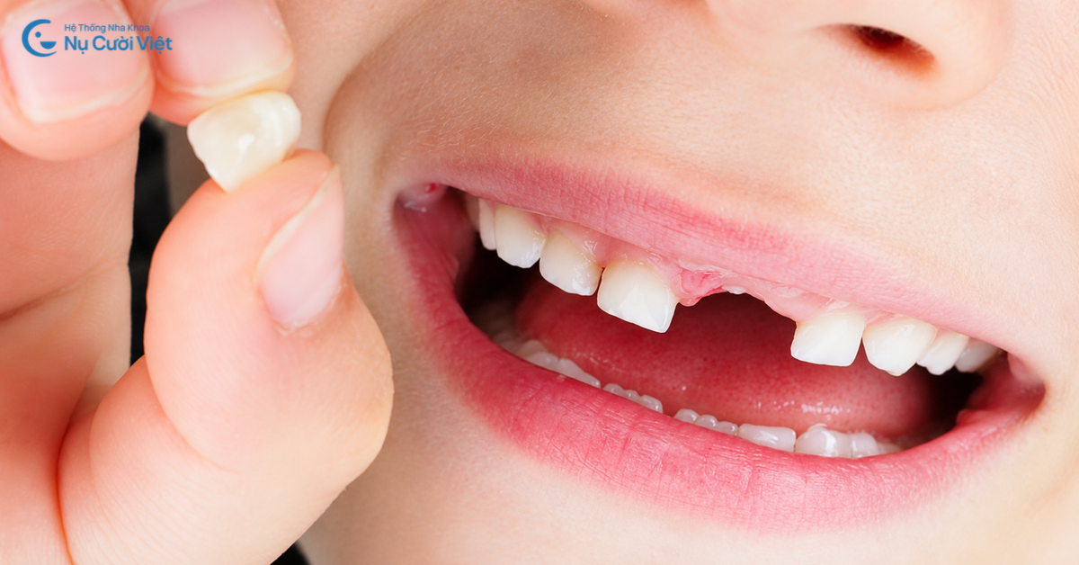 ường hợp nhổ răng không cần trồng lại