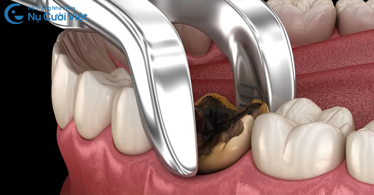 trường hợp được nhổ khi răng đang đau nhức