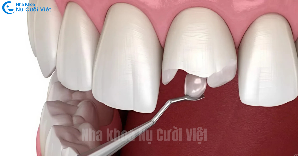 vật liệu để trám răng cửa sâu phù hợp nhất