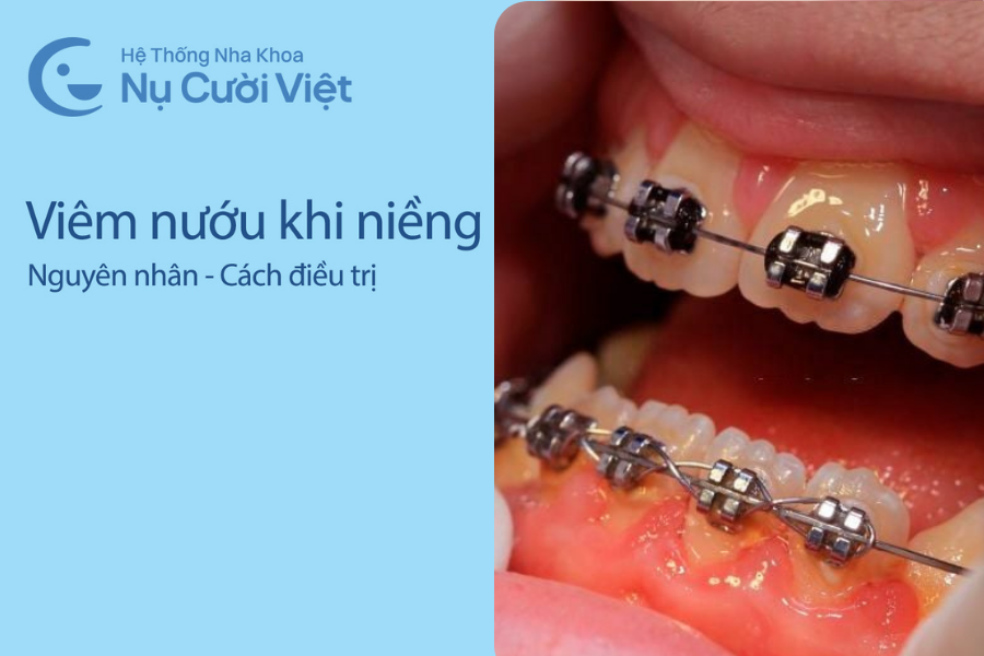 Nụ Cười Việt - Viêm nướu khi niềng răng: Nguyên nhân và cách điều trị hiệu quả