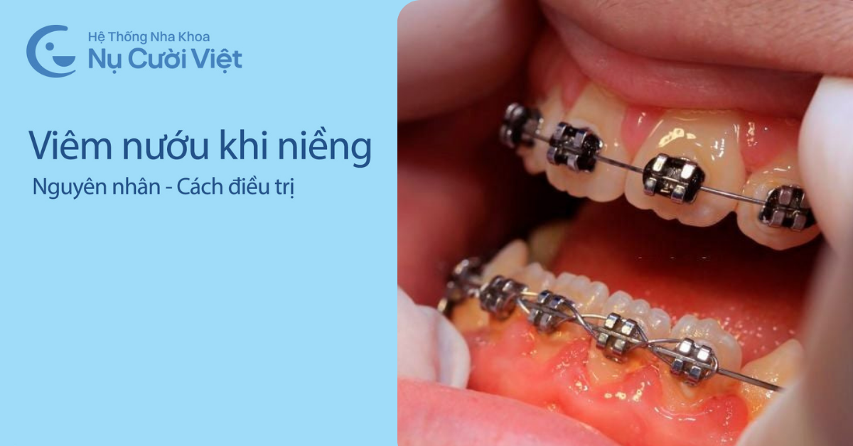 viêm nướu khi niềng răng