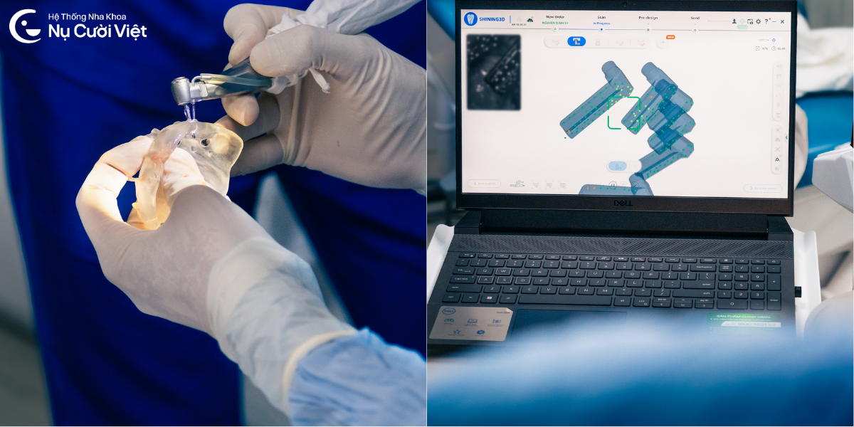 công nghệ implant hiện đại